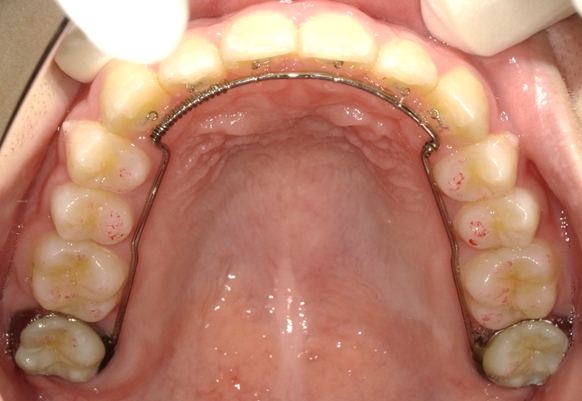 違和感がなくできるだけ口腔機能に支障のない装置による矯正歯科治療